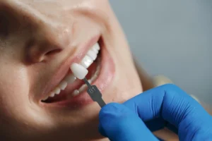 Beneficios de las carillas dentales