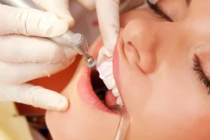 Beneficios del bonding dental