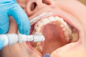Procedimiento de bonding dental